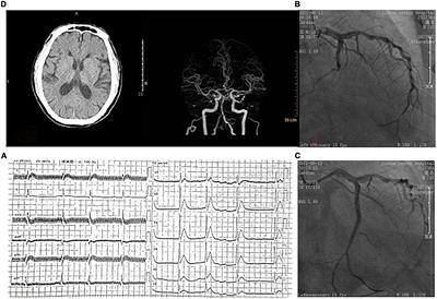 Concurrent acute myocardial infarction and acute ischemic stroke: Case reports and literature review